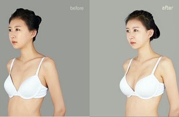 avant et après augmentation mammaire