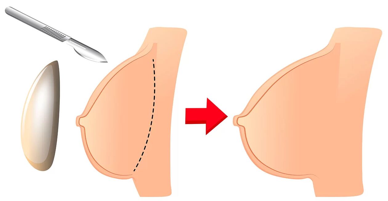 Augmentation mammaire avec une prothèse