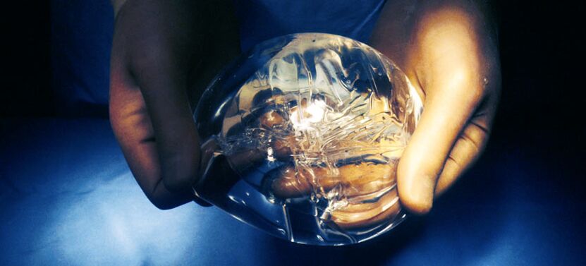 Endoprothèse en silicone